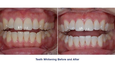 teeth whitening average cost