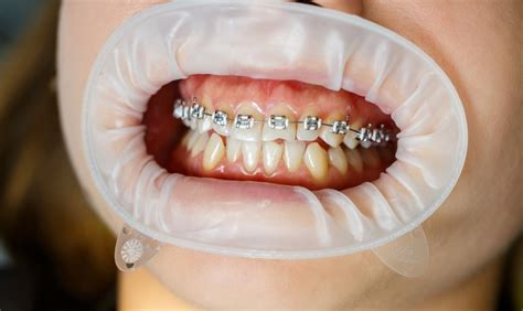 Teeth Whitening During Braces
