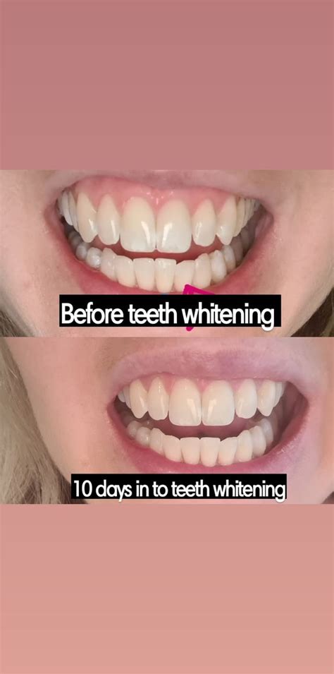 Teeth Whitening Toothpaste Not Working