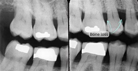 Teeth X Ray Bone Loss