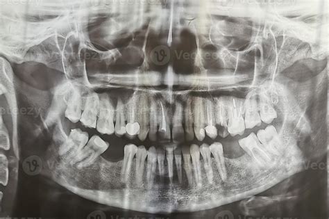 Teeth X Ray Images