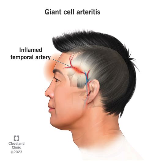Effective Temporal Arteritis Treatment Options for Immediate Relief