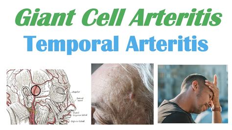 Effective Temporal Arteritis Treatments for Long-Term Relief Found