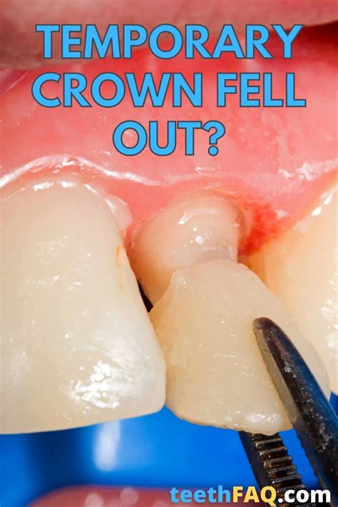 Temporary Cap For Tooth Fell Off