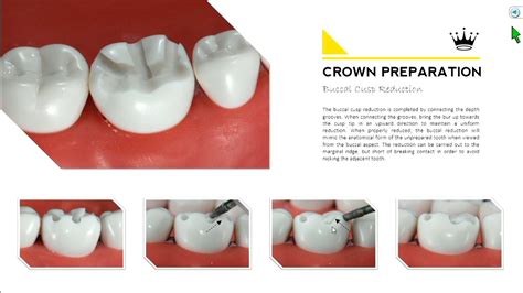 Temporary Crown Recement Code