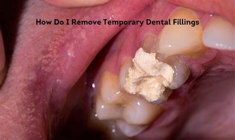 Temporary Filling Fell Out