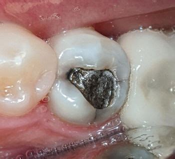 Temporary Filling Turned Black