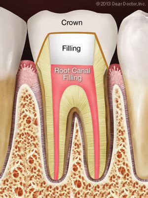 Temporary Tooth Filling Before Root Canal