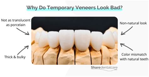Temporary Veneers Look Bad