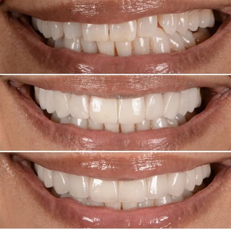 Temporary Veneers Pictures