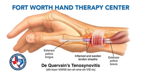 Tendonitis Quizlet