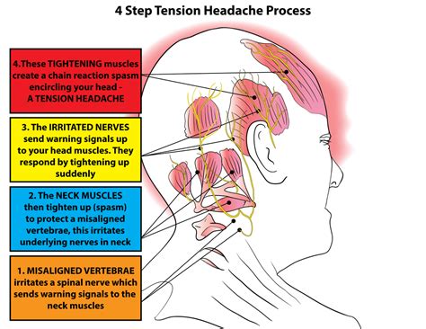 Relieve Tension Headache Therapy for Lasting Pain Relief Today