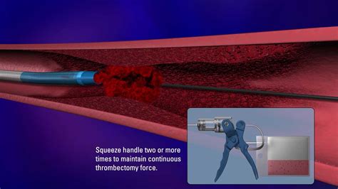 Terumo Thrombectomy Device