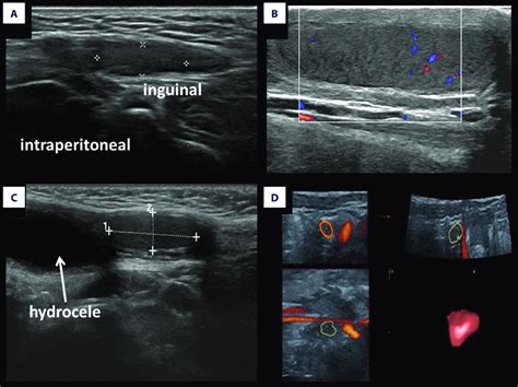 testicle in inguinal canal ultrasound