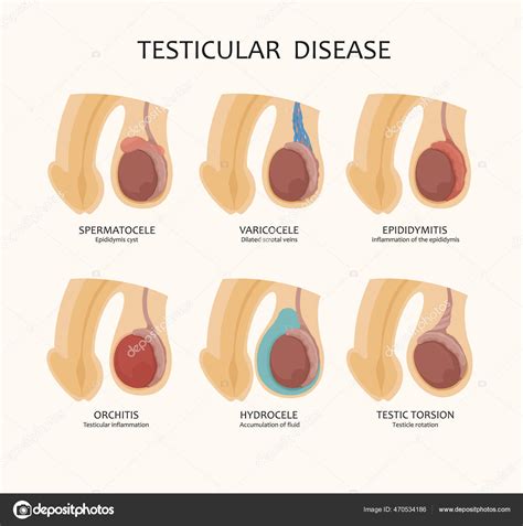 Testicles Disease Images