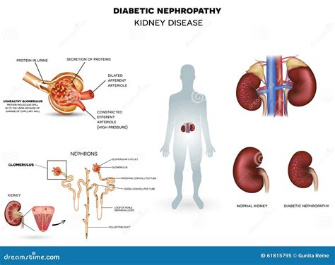 Testing For Diabetic Nephropathy