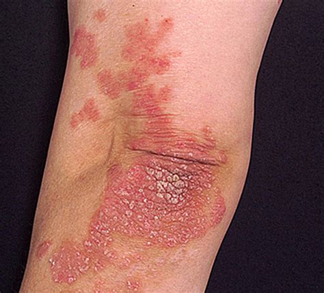 the definition of psoriasis