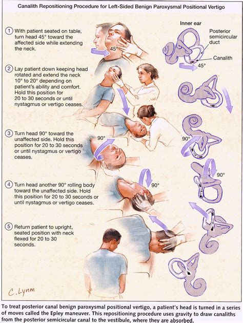 the epley maneuver procedure pdf