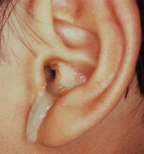 the flow of pus from the ear medical term