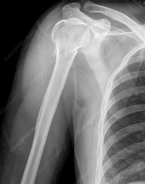 The Humerus Bone Fracture