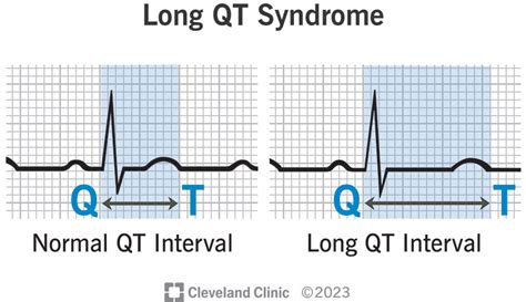 the long qt syndrome