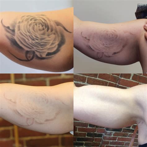 the removery tattoo removal
