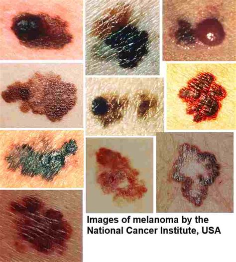 the spot black form of melanoma