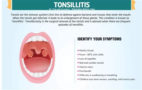 the symptoms of tonsillitis
