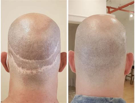 the truth about hair transplants