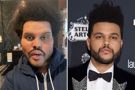 the weeknd plastic surgery fake