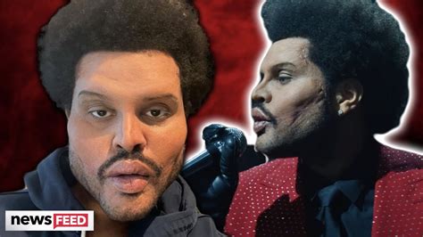 the weeknd plastic surgery real