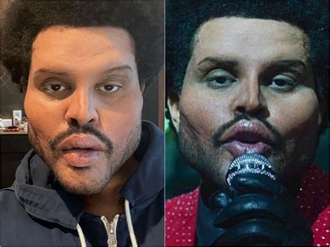 the weeknd plastic surgery video