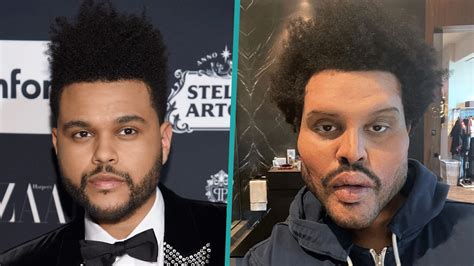 the weeknd what happened to his face