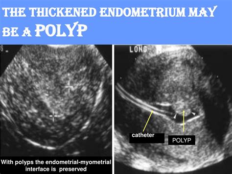 Thickened Endometrium With Polyp