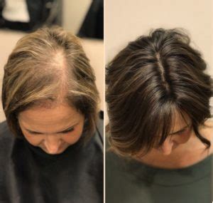 Thinning Hair On Top Of Head Female Causes  Understanding The Problem