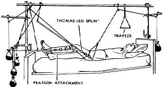 Thomas Splint And Pearson Attachment