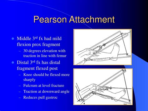 Thomas Traction Splint for femur fractures orthopaedic teaching video