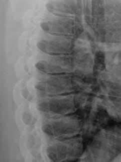 thoracic spine x ray 1 view cpt code