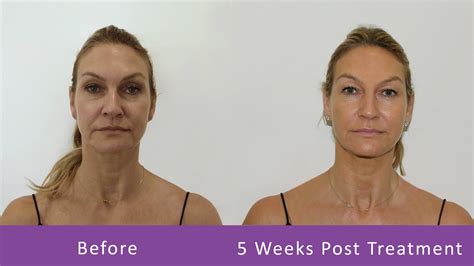 Thread Lifting How Long Does It Last