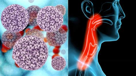 throat cancer hpv related
