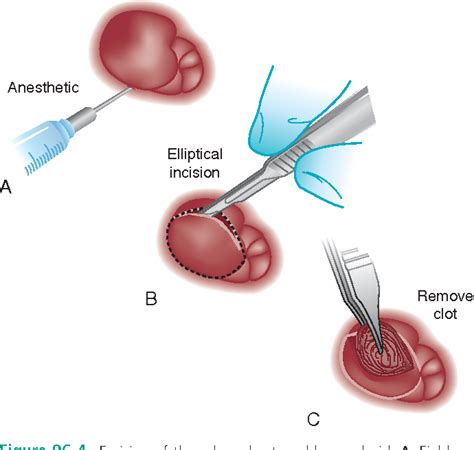 Thrombosed External Hemorrhoid Excision