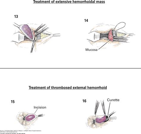 Thrombosed Haemorrhoids Uk