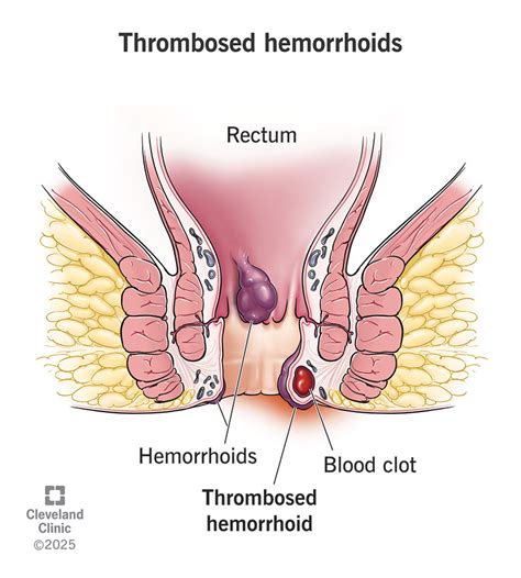 Thrombosed Hemorrhoid Wiki