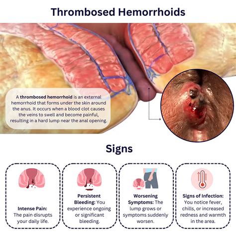 Thrombosed Hemorrhoids Code