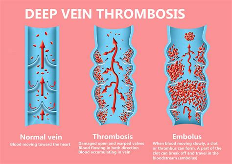 thrombosis vs embolism meaning