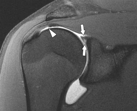 Throwing Labral Tear