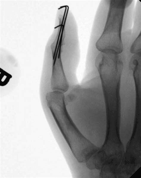 Thumb Dip Joint Fusion