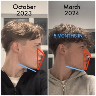 Interoral facepulling (thumbpulling) after teeth extractions? r/orthotropics