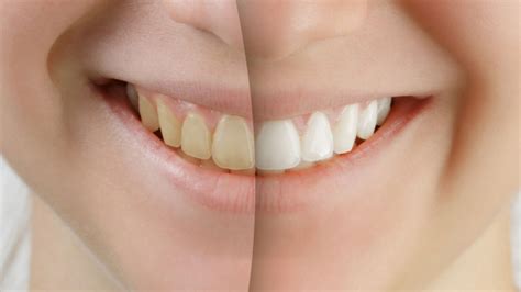 thunder and whitening