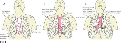 Thymectomy Sternotomy